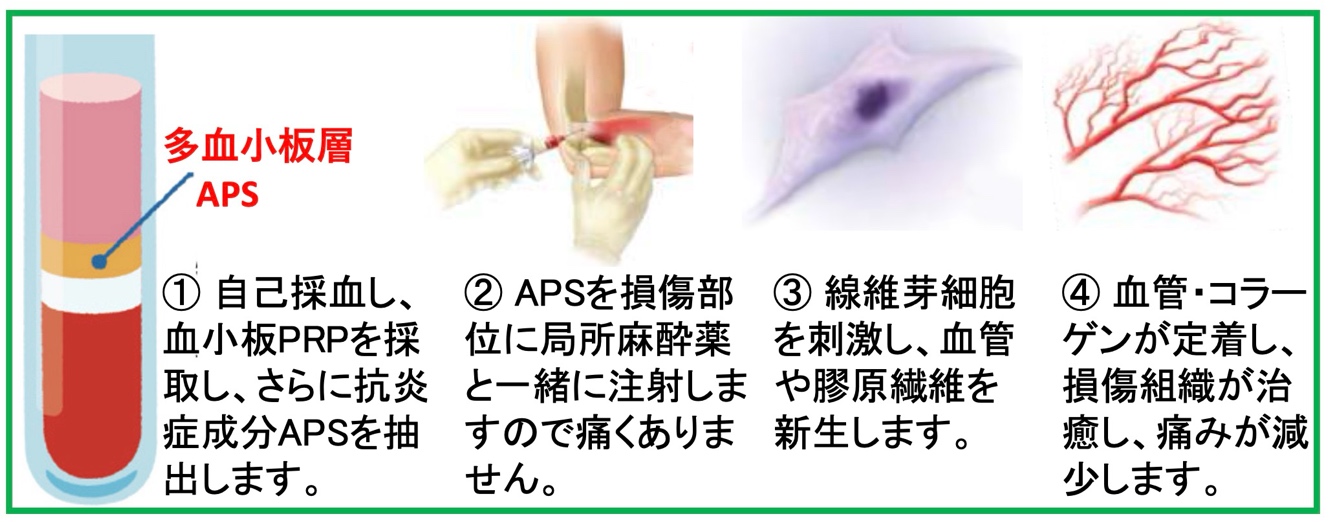 次世代PRP療法APS(Autologous Protein Solution)