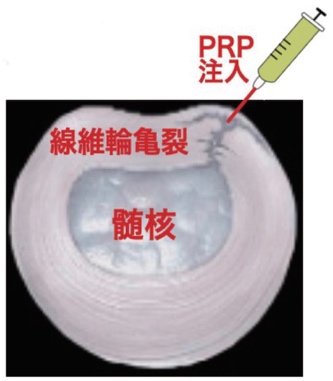 椎間板線維輪の亀裂修復
