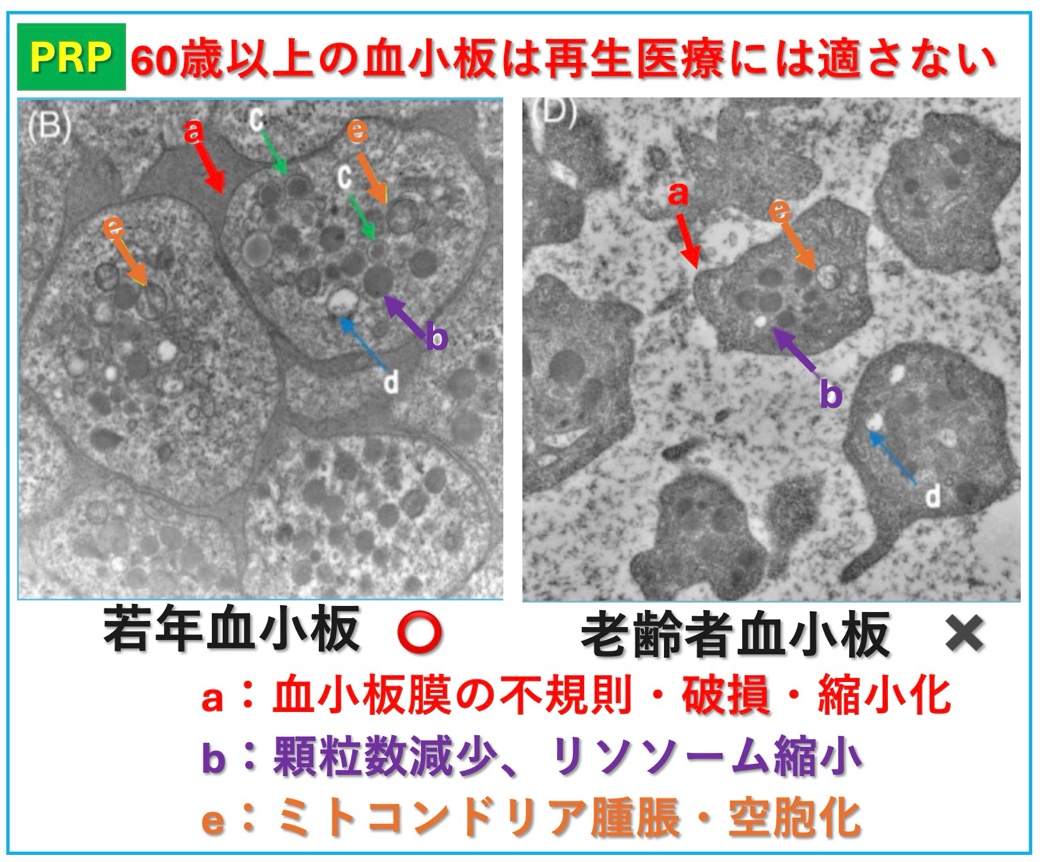 血小板再生医療の適応年齢は?
