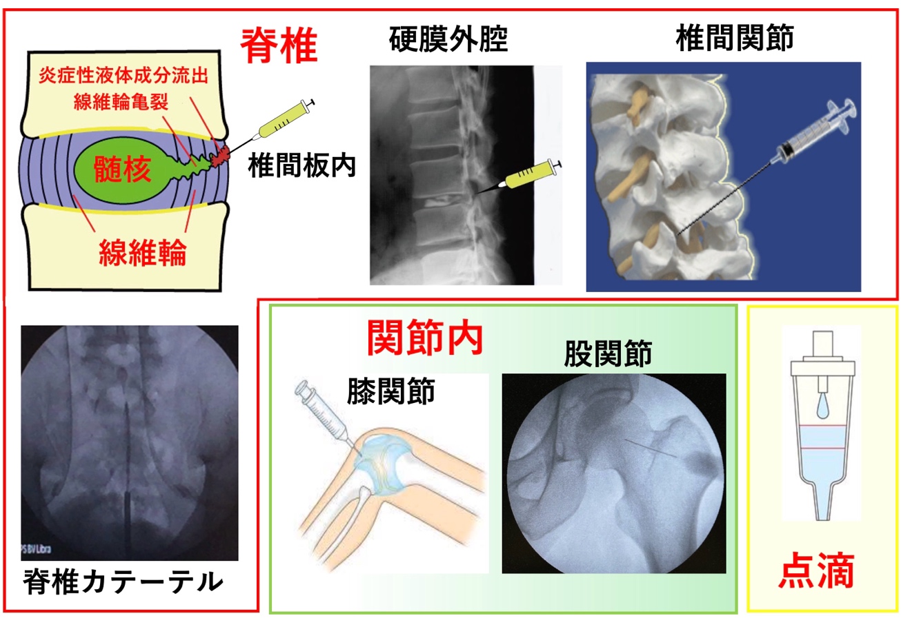 再生医療の投与用法
