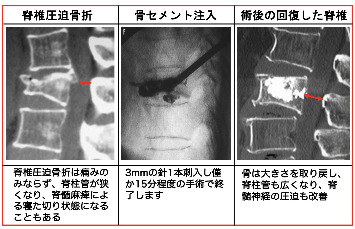 脊椎圧迫骨折は寝たきりになる大きな要因