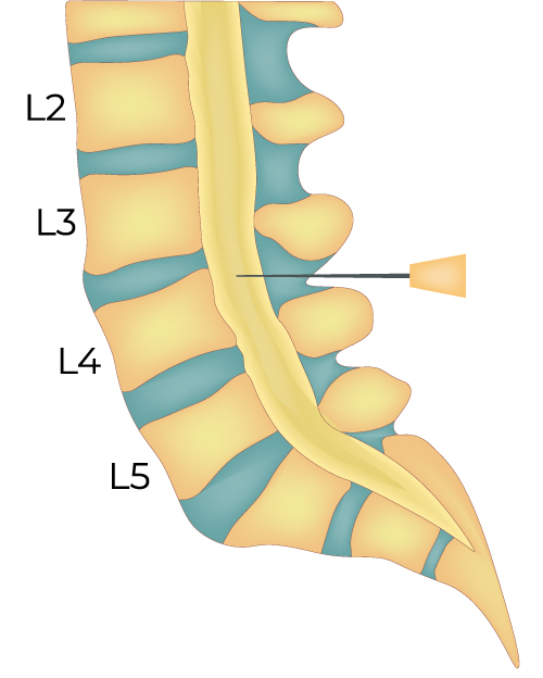 脊椎内幹細胞注入