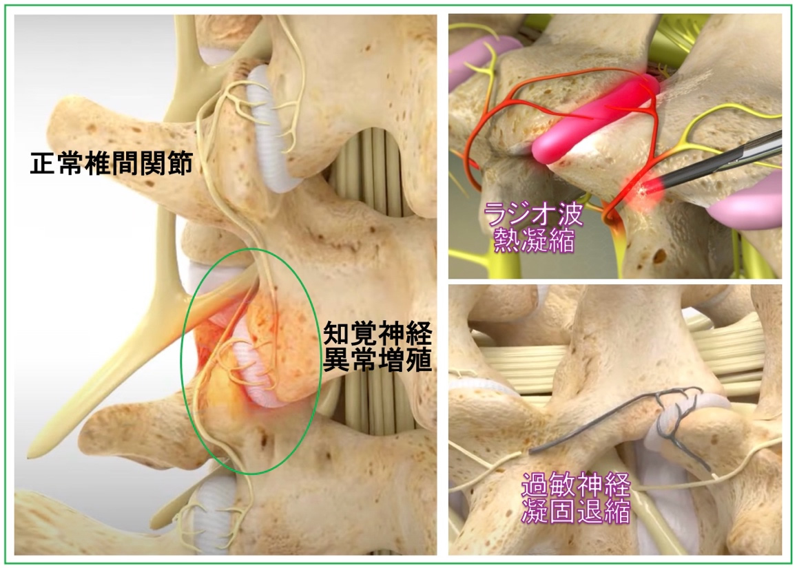 椎間関節過敏知覚神経ラジオ波焼却 Rhizotomy