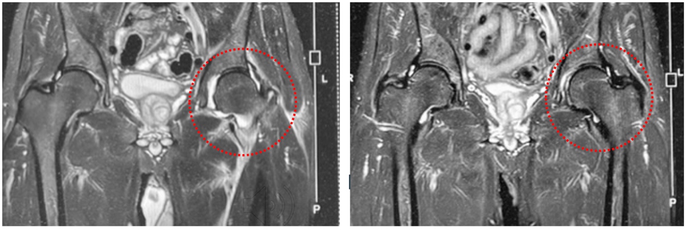 股関節包炎に対する乳歯髄幹細胞上清液の抗炎症作用