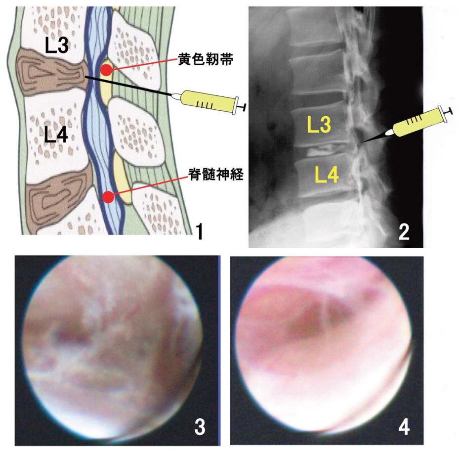 幹細胞は脊柱管狭窄症を軽減する